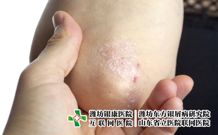 攝圖網(wǎng)_502556199_手肘上的絲蟲(chóng)（企業(yè)商用）