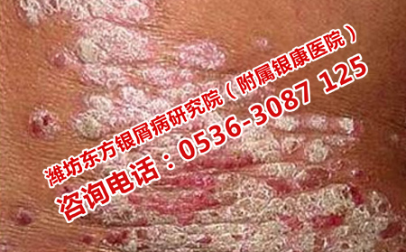 治療牛皮癬實(shí)力醫(yī)院