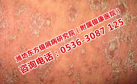 護(hù)理牛皮癬的常識(shí)