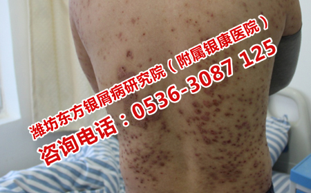 牛皮癬患者日常吃點(diǎn)什么理想