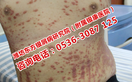 為什么會(huì)得膿皰型牛皮癬
