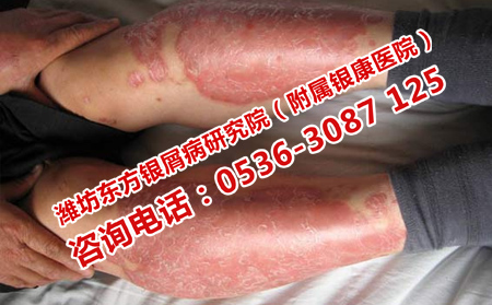 預防牛皮癬短期復發(fā)的方法