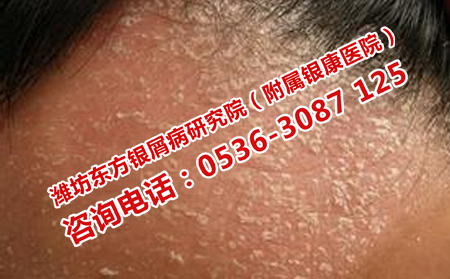 如何預防牛皮癬再三發(fā)作