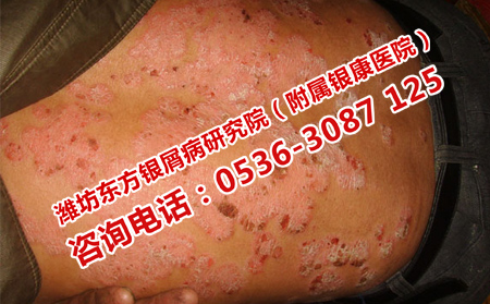 如何預防銀屑病頻繁復發(fā)