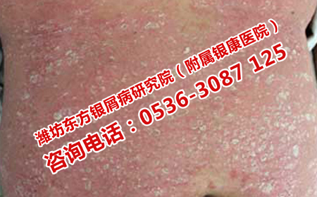 高密理想點(diǎn)的牛皮癬醫(yī)院