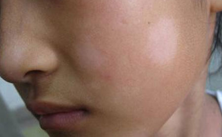 白癜風(fēng)的預(yù)防,白癜風(fēng)的危害