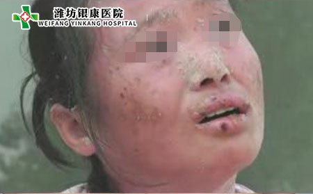 濰坊牛皮癬醫(yī)院：中藥治療牛皮癬